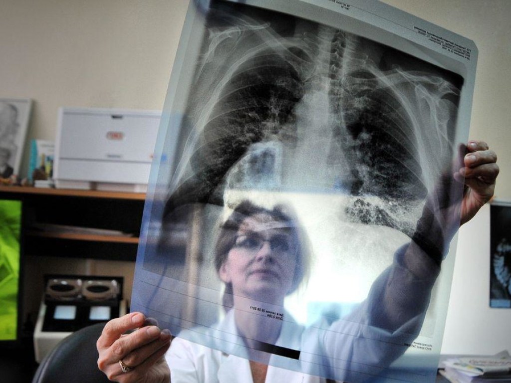 «Эпидемия  в Украине»:  мультирезистентный туберкулез хуже, чем коронавирус  – эксперт