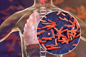В июле в Украине зарегистрировали 1530 случаев туберкулеза, – ЦОЗ